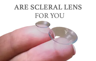 Patient in Cambridge, ON wearing scleral lenses for keratoconus